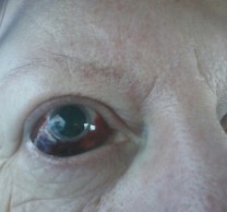 padel injury on eye.jpg
